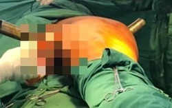 
Nam thanh niên 19 tuổi bị ống sắt đâm xuyên vùng bẹn