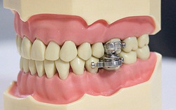 Thiết bị giảm cân "độc lạ" khiến người sử dụng không thể há miệng quá rộng