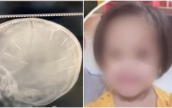 Hội LHPN TP Hà Nội thăm hỏi bé gái 3 tuổi bị người tình của mẹ đóng 9 chiếc đinh vào đầu
