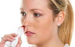 Sốt xuất huyết chảy máu cam có nguy hiểm không? 