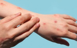 Người dân không nên quá lo lắng khi Việt Nam ghi nhận ca bệnh đậu mùa khỉ thứ hai