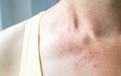 Phân biệt viêm da cơ địa và chàm