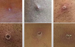 Hình ảnh các nốt đậu mùa khỉ qua các giai đoạn bệnh và cách phân biệt