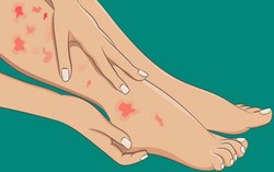3 đặc điểm ở bàn chân cảnh báo mạch máu bị tắc nghẽn