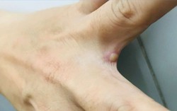 Vết mụn nước ở ca mắc đậu mùa khỉ tại Việt Nam có nguy hiểm? Chuyên gia người Việt tại Đức lý giải