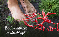 Bệnh nhi 15 tuổi tử vong vì nhiễm vi khuẩn gây bệnh Whitmore: Bệnh nguy hiểm như thế nào?