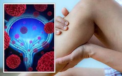 Gặp những biểu hiện này khi đi tiểu, coi chừng bệnh ung thư bàng quang đang "tìm đến" bạn