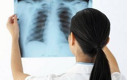 Phát hiện trên 76.000 người mắc bệnh lao