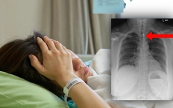 Cô gái nuốt phải dây sạc điện thoại dài 1 mét