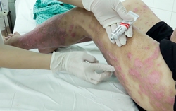 Nhiều trường hợp nhập viện do tự ý sử dụng thuốc chữa vảy nến mua trên mạng