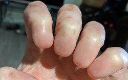 Anonychia - Tình trạng hiếm gặp, khiến cho con người không có móng tay và móng chân