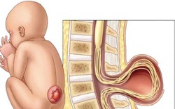 Thử nghiệm liệu pháp tế bào gốc trị tật nứt đốt sống