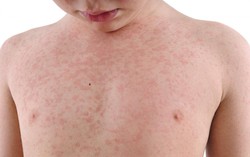 Trẻ phát ban sau sốt có được tắm không?