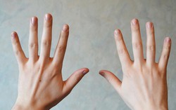 7 dấu hiệu ở tay cảnh báo sức khoẻ có vấn đề
