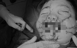 Đưa pháo lên miệng, bé 9 tuổi bị nát mặt