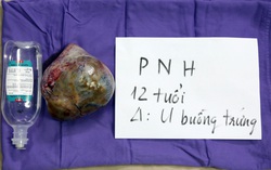 Trẻ 12 tuổi mang khối u buồng trứng nặng 2kg