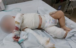 Người lớn nướng mực, bé 2 tuổi bị bỏng nặng
