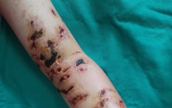 Bé 10 tuổi chằng chịt vết thương do bị sứa đốt