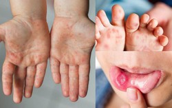 1 trường hợp tử vong do tay chân miệng, Bộ Y tế ra công văn khẩn