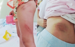 Vụ bố dượng bị tố bạo hành con riêng của vợ: Phục hồi giải quyết nguồn tin tố giác tội phạm