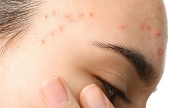 Mụn ở tuổi dậy thì có hết không? Cách xử lý mụn ở tuổi dậy thì