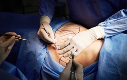 Lý do hút mỡ làm đẹp có thể gây tử vong