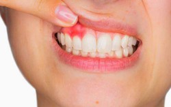 Nguy hiểm khôn lường khi sốt xuất huyết chảy máu chân răng