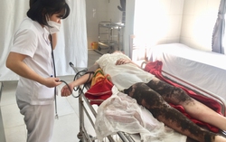 Đắp thuốc nam trị bỏng, thiếu nữ suýt mất đôi chân