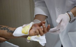 Chạy đua "cứu sống" bàn tay gần đứt lìa của người đàn ông 32 tuổi