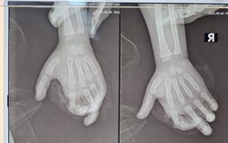 Cho tay vào máy ép hoa quả, bé 4 tuổi bị nghiền nát 2 ngón tay