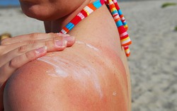 Nên xử lý thế nào khi bị ngộ độc ánh nắng mặt trời?
