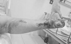 Bị hoại tử, phải cắt cụt chân do mắc đái tháo đường nhưng không điều trị
