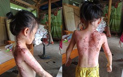 Ghen tuông, người phụ nữ tạt nước sôi khiến 2 cháu bé bỏng nặng