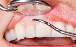 10 cách chữa viêm nha chu bằng phương pháp dân gian đơn giản, hiệu quả