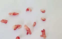 Người có 10 chiếc răng ngầm 