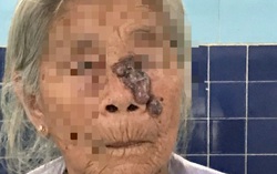 Từ nốt ruồi trên mặt, sau 3 tháng đi khám phát hiện ung thư da