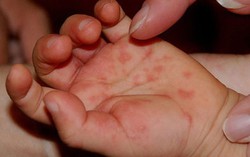 Bị chân tay miệng có phải kiêng gió không?
