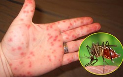 Trẻ bị sốt xuất huyết làm gì cho nhanh khỏi?