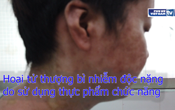 Hoại tử thượng bì nhiễm độc nặng do sử dụng thực phẩm chức năng
