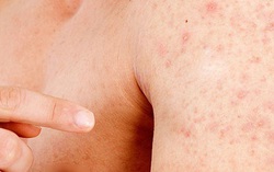 Da nổi những hạt nhỏ không ngứa có nguy hiểm không?