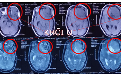 Thai phụ 22 tuần có khối u não lớn