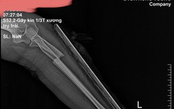 Suýt hỏng tay do đắp thuốc Nam trị gãy tay 