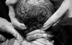 Bé sơ sinh chào đời với 5 vòng dây rốn quấn cổ
