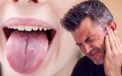 Người đàn ông bị nhiệt miệng, đi khám bàng hoàng khi biết đã ung thư giai đoạn 4