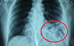 Tưởng hậu Covid-19, đi khám thì được phát hiện vỡ cơ hoành