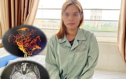 Bị huyết khối tĩnh mạch não do lạm dụng thuốc tránh thai đường uống