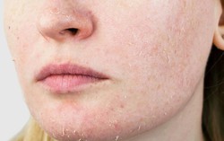 Nắng đã bớt gắt hơn nhưng vì sao tình trạng da của bạn vẫn không tốt lên