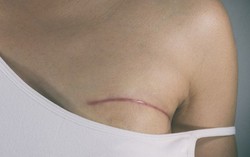 Có 7 yếu tố này trong cuộc sống, bạn có nguy cơ mắc ung thư vú cao hơn