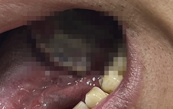 Tưởng nhiệt miệng, đi khám phát hiện ung thư lưỡi giai đoạn 4