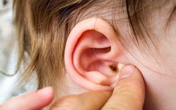 Biến chứng đáng sợ của viêm tai giữa và cách phòng tránh từ chuyên gia